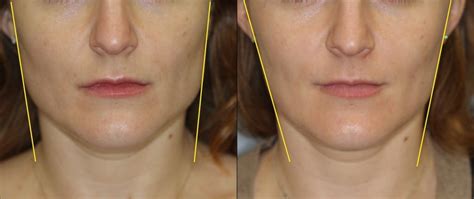 Botox for Masseter Muscle Hypertrophy - New York City - Dr. Dara Liotta