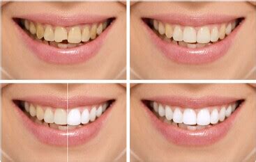 how to whiten teeth at home with hydrogen peroxide