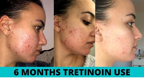 Tretinoin Sun Damage Cream (Retin-A) | ubicaciondepersonas.cdmx.gob.mx