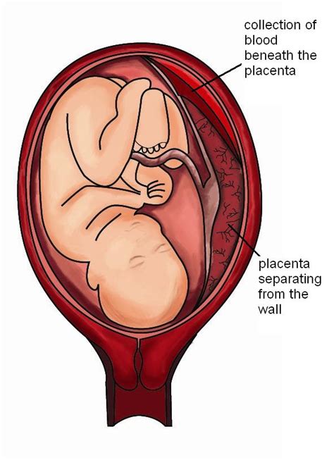 Placental Abruption