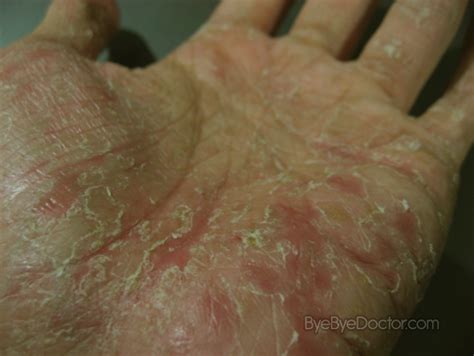 Dyshidrotic Eczema – Pictures, Causes, Home Remedies, Treatment | Symptoms Causes Treatment and ...