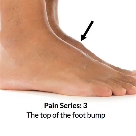 "Top of Foot" Pain