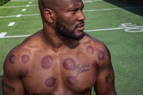 Pin on Celebrities Love Cupping