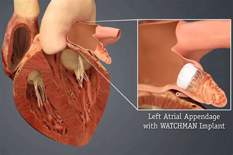 Watchman Implant | Hartford HealthCare | CT