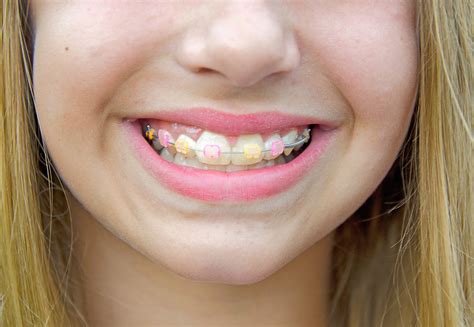 Clear Braces with Color Bands Make Your Smile Pop! - Erie, CO