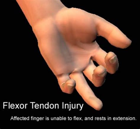 Tendon Injuries of the Hand - YouMeMindBody