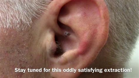 Ear Blackhead Extraction | Dr Steven Greene in Seattle