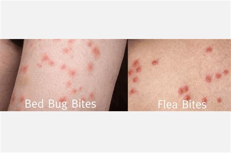 Bed Bug Vs Flea Bites