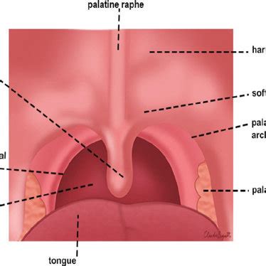 The uvula and its morphological anatomical variations: (A) common ...