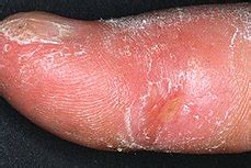 Systemic scleroderma - Wikipedia, the free encyclopedia