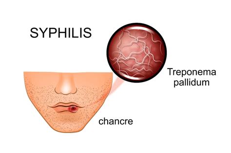 Secondary Syphilis- The Great Imitator and Pretentious Rash - Dr Ben ...