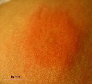 Bee Sting - symptoms, treatment, allergic reactions, learn how a bee stings