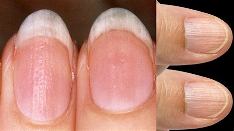 What Causes Ridges In Fingernails And Toenails - Design Talk