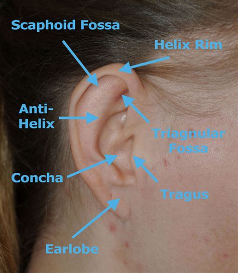 Macrotia Large Ear Reduction Prominent Ear Pinning Otoplasty