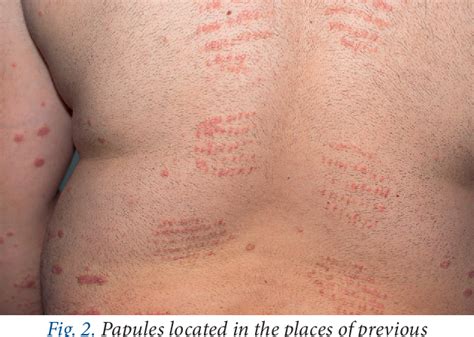 Koebner phenomenon caused by bloodletting and cupping therapy in a patient with psoriasis ...