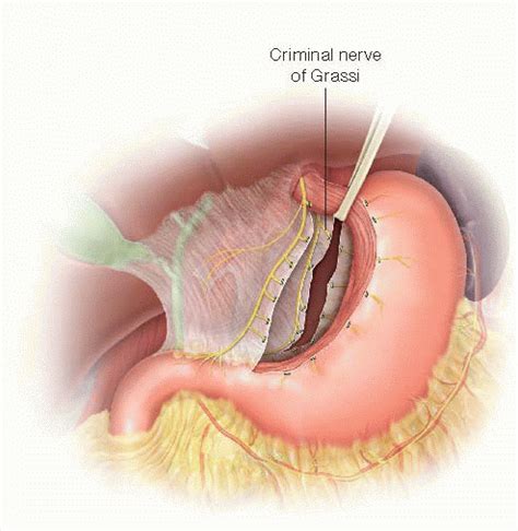 Vagotomy: Truncal and Highly Selective | Basicmedical Key