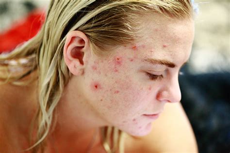 Keratosis Pilaris on Face: How to Deal with It | Keratosis Pilaris Help