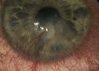 Corneal Phlyctenule