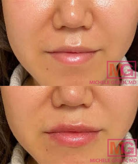 Vertical Lip Lines, Best Fillers & How To Reduce Vertical Lip Lines