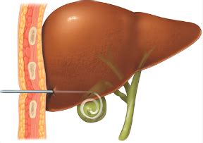 Percutaneous Cholecystostomy