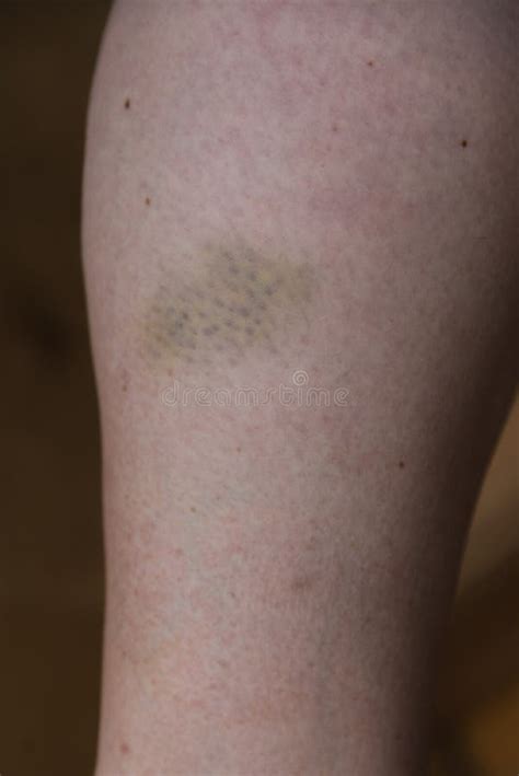 Bruise on the Lower Leg - Hematoma Stock Image - Image of bruise, closeup: 274012441