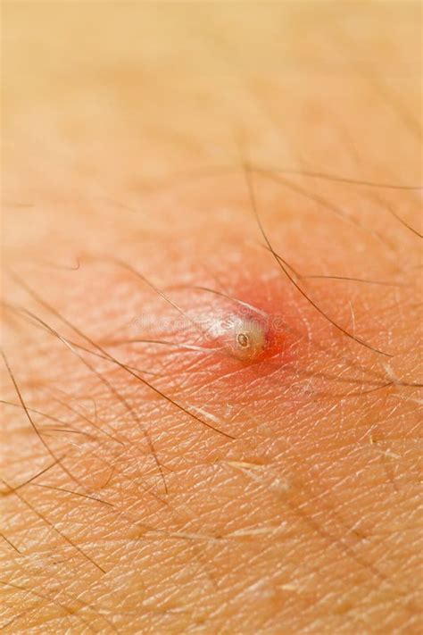 Pimple-Extrem-Makro stockbild. Bild von hautentzündung - 14887981