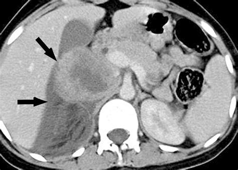 Spontaneous rupture of a right pheochromocytoma. Axial... | Download ...