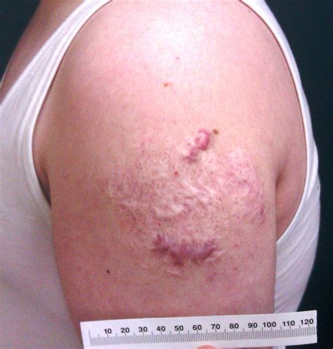 BCG induced lupus vulgaris: an unexpected adverse event | Archives of Disease in Childhood