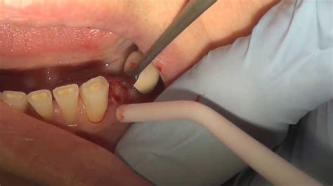 How to pull a broken tooth - YouTube
