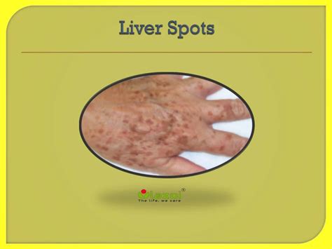 Liver Spots On Arms Photos