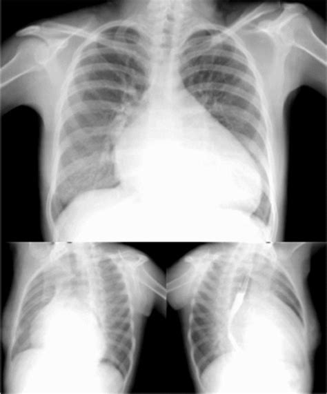 Chest x-ray showing severe cardiomegaly with compression of esophagus... | Download Scientific ...