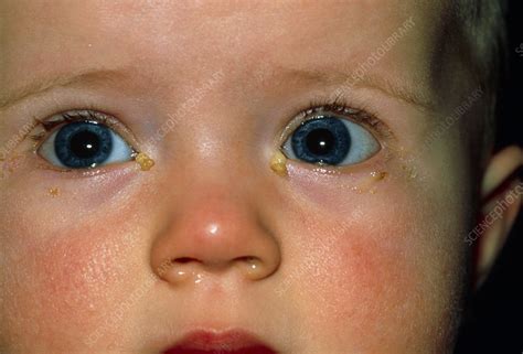 Close-up of baby's eyes with acute conjunctivitis - Stock Image M155 ...