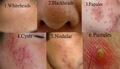 The Truth about Acne