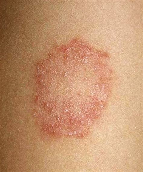 Tinea Corporis - Pictures, Treatment, Causes, Symptoms | HubPages