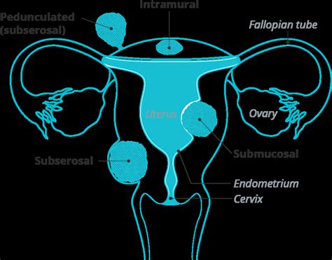 What Is a Subserosal Fibroid? - Responsum Health