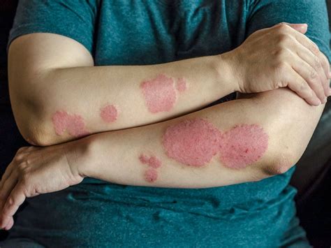 Reasons Why Your Psoriasis Treatment Isn't Working