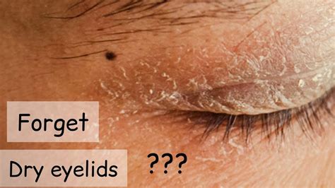 Dry Eyelids: Causes, Treatments, And Home Remedies, 60% OFF
