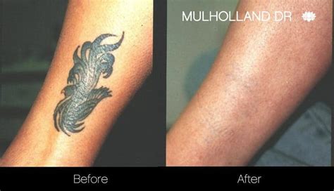 Discover 52+ tattoo removal before after pictures super hot - in.cdgdbentre