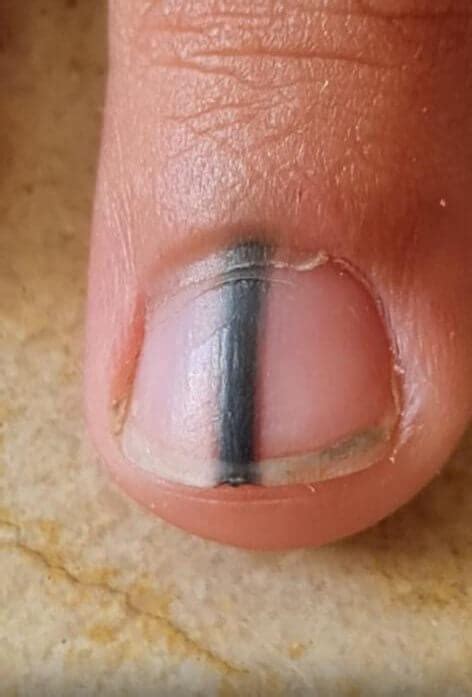 A Black Pigmentation Of The Nail – Melanonychia