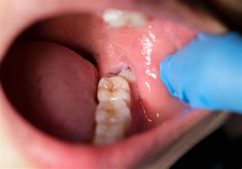 Why Do My Wisdom Teeth Smell So Bad? (Causes & Treatment)