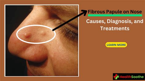 Fibrous Papule On Nose | Causes, Diagnosis, And Treatments