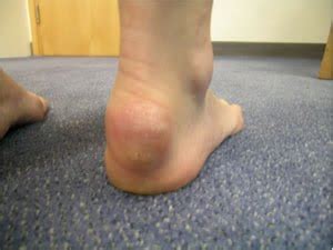 How To Treat A Lump On Your Achilles Tendon In 2023 | atelier-yuwa.ciao.jp