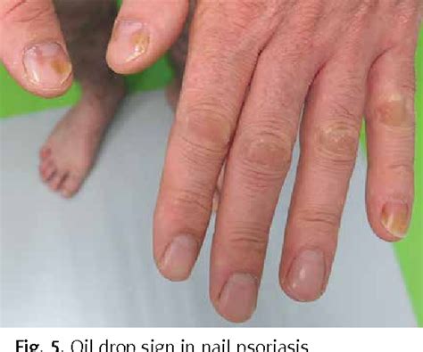 Share more than 124 nail pitting psoriasis best - songngunhatanh.edu.vn