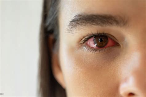 Eye flu treatment at home : Symptoms, Cause and 5 easy tips.