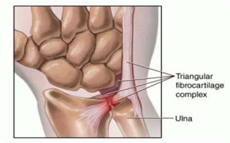 TFCC – Dr. Satvir Singh