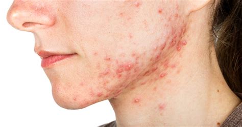 Nodular Acne: Treatment, Causes & Symptoms | Acne Nodules