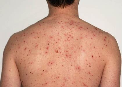 Red Spots On Shoulders