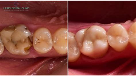 Do You Have Rotten Teeth? Symptoms, Pain, and Treatment