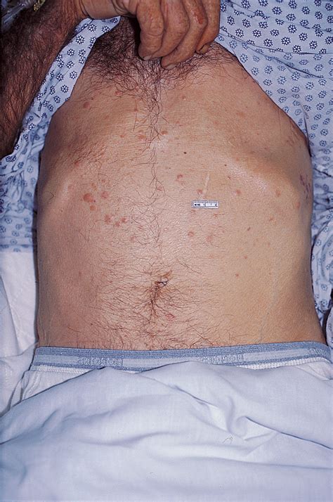 Subcutaneous Skin Nodules