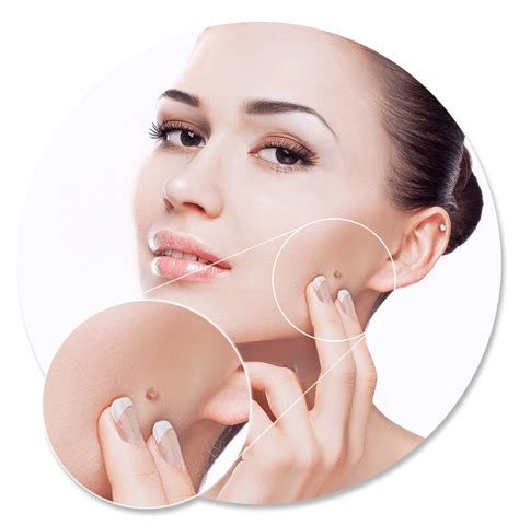Facial Warts Removal Philippines: Facial treatment for warts